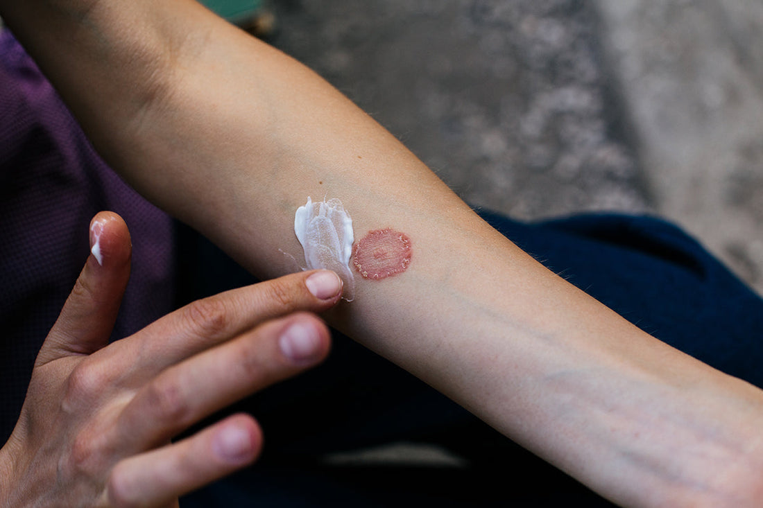 What Is Ringworm? Causes, Symptoms, and How to Treat It Effectively