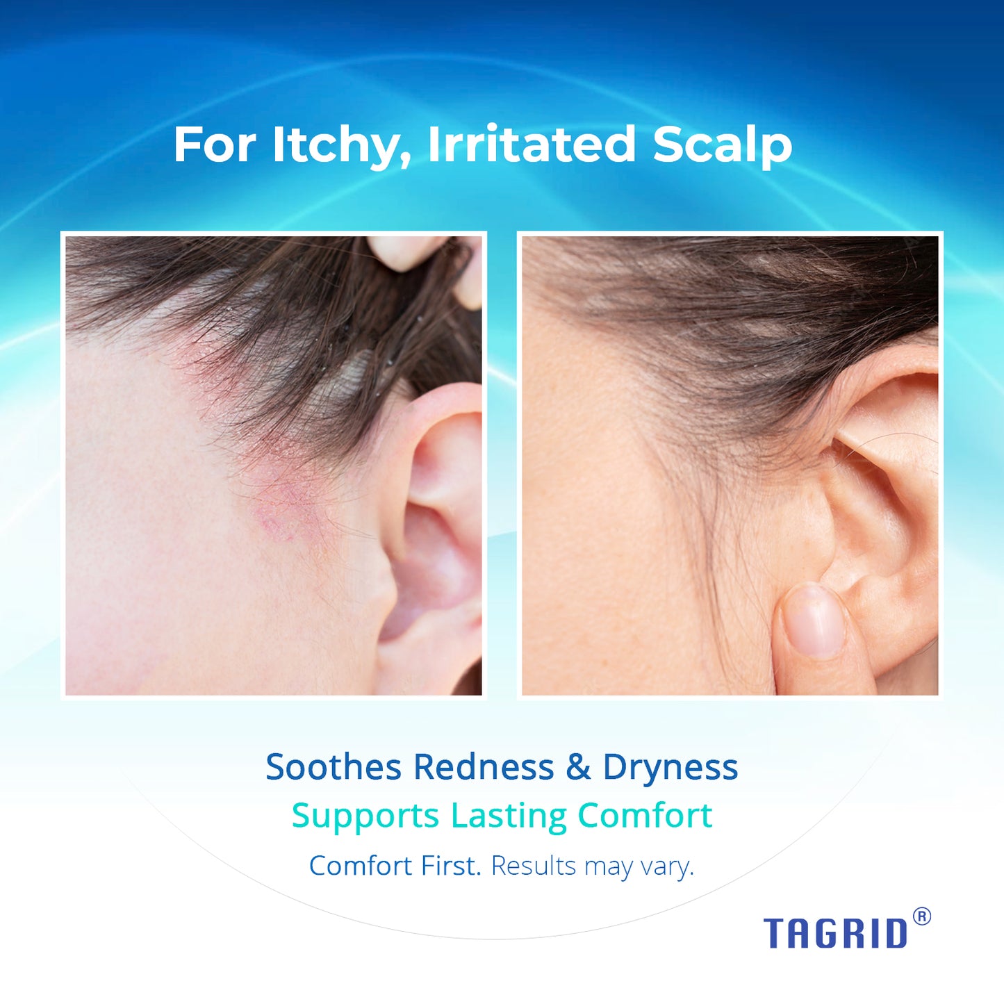 TAGRID 1% Ketoconazole Scalp Support Shampoo - Soothes itchy, irritated scalp and supports lasting comfort. Ideal for dandruff and seborrheic dermatitis.