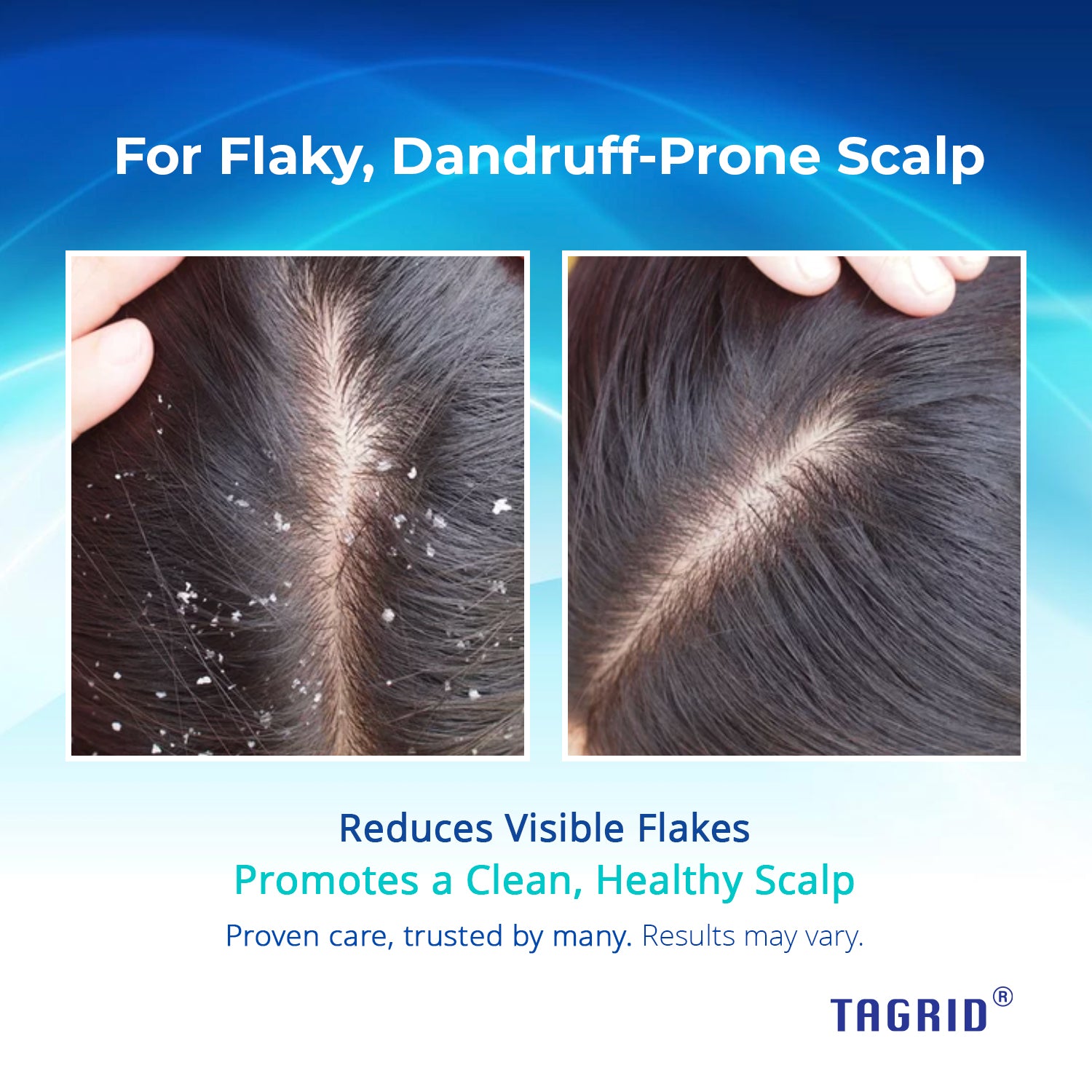 TAGRID 1% Ketoconazole Scalp Support Shampoo - Reduces visible flakes and promotes a clean, healthy scalp. Proven results in dandruff control and comfort.