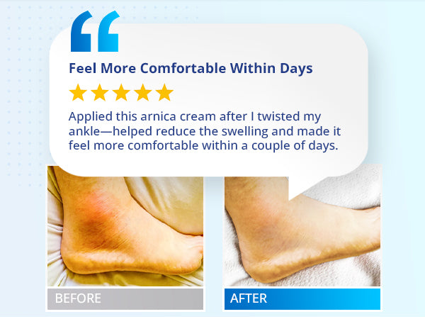 Customer review of TAGRID Arnica Cream showing its success in reducing swelling and aiding recovery from bruises