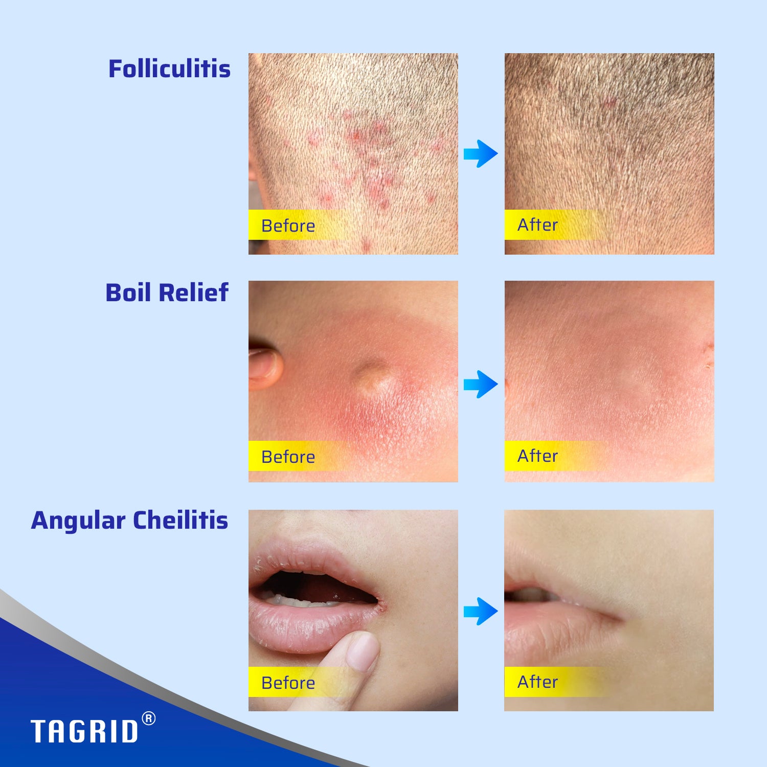 TAGRID Skin Repair Ointment for Folliculitis, Boil Relief, and Angular Cheilitis. Before and After images showing effective skin healing and relief. 1 oz.