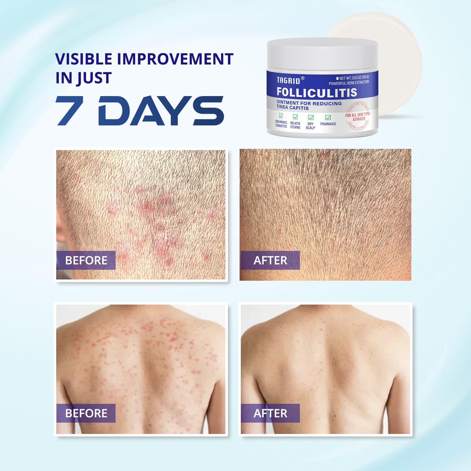 TAGRID folliculitis relief supports visible skin improvement over time for smoother and healthier looking skin