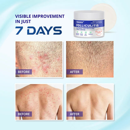 TAGRID folliculitis relief supports visible skin improvement over time for smoother and healthier looking skin