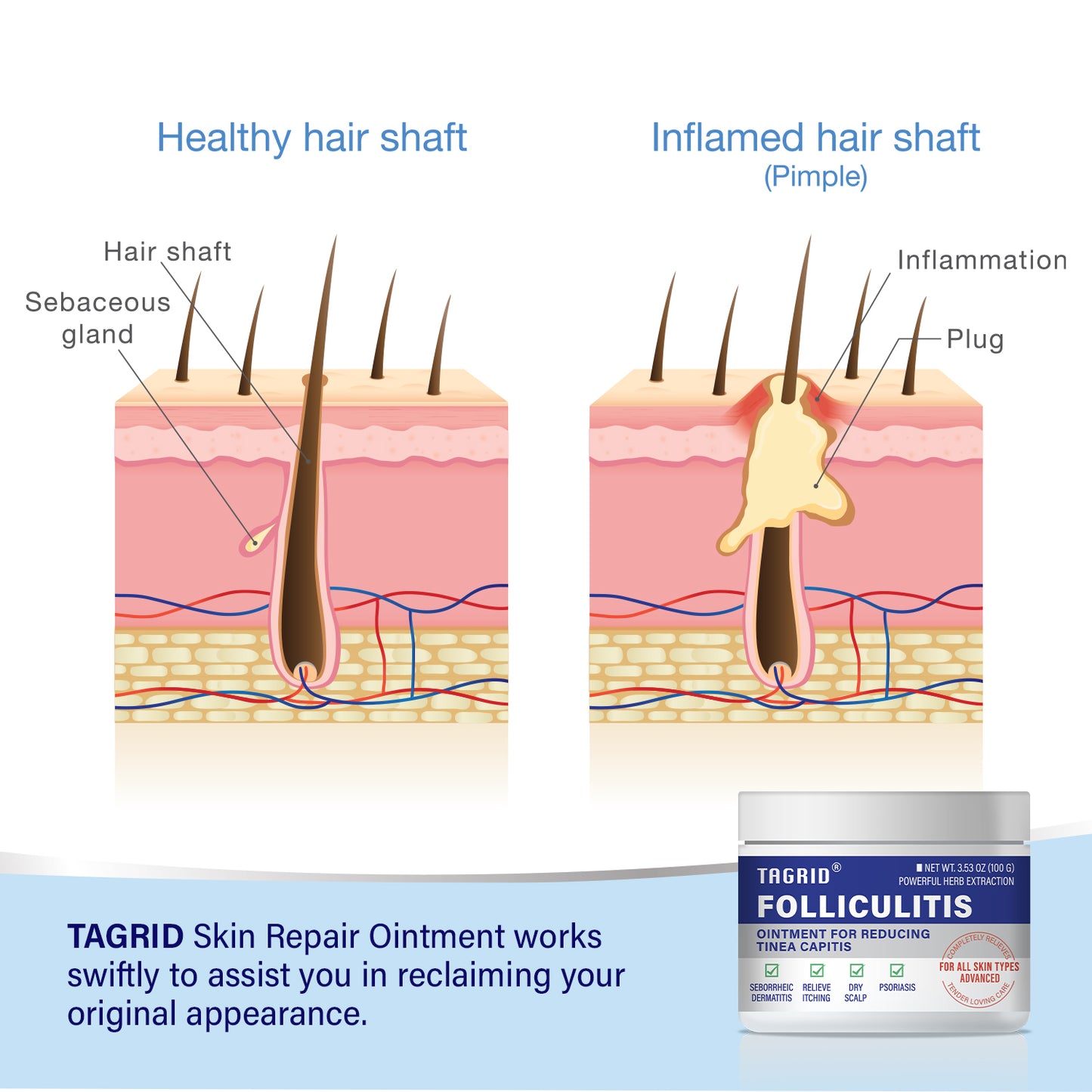 TAGRID folliculitis treatment diagram shows how antifungal ointment helps reduce inflammation unclog hair follicles and improve ingrown hair conditions