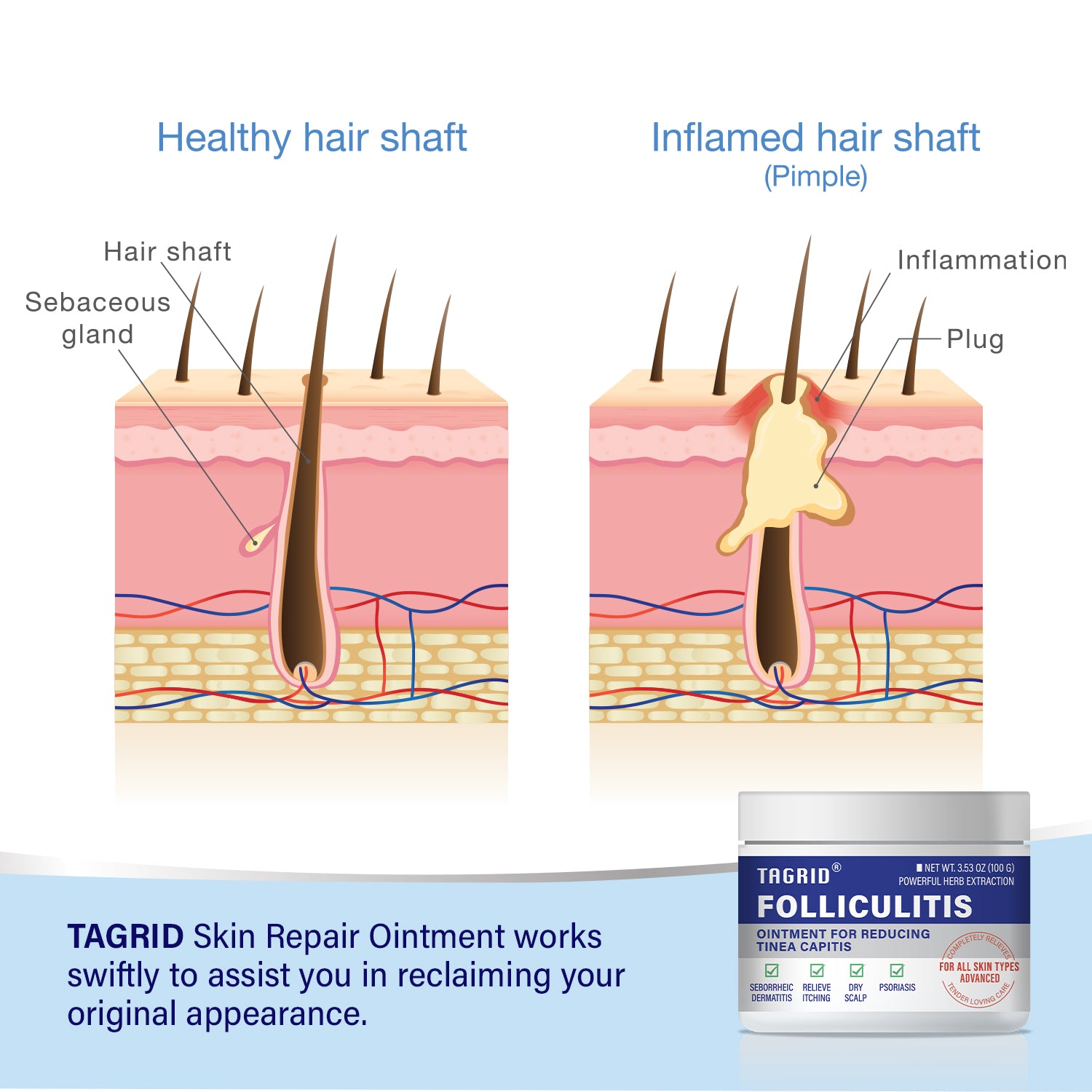 TAGRID folliculitis treatment diagram shows how antifungal ointment helps reduce inflammation unclog hair follicles and improve ingrown hair conditions