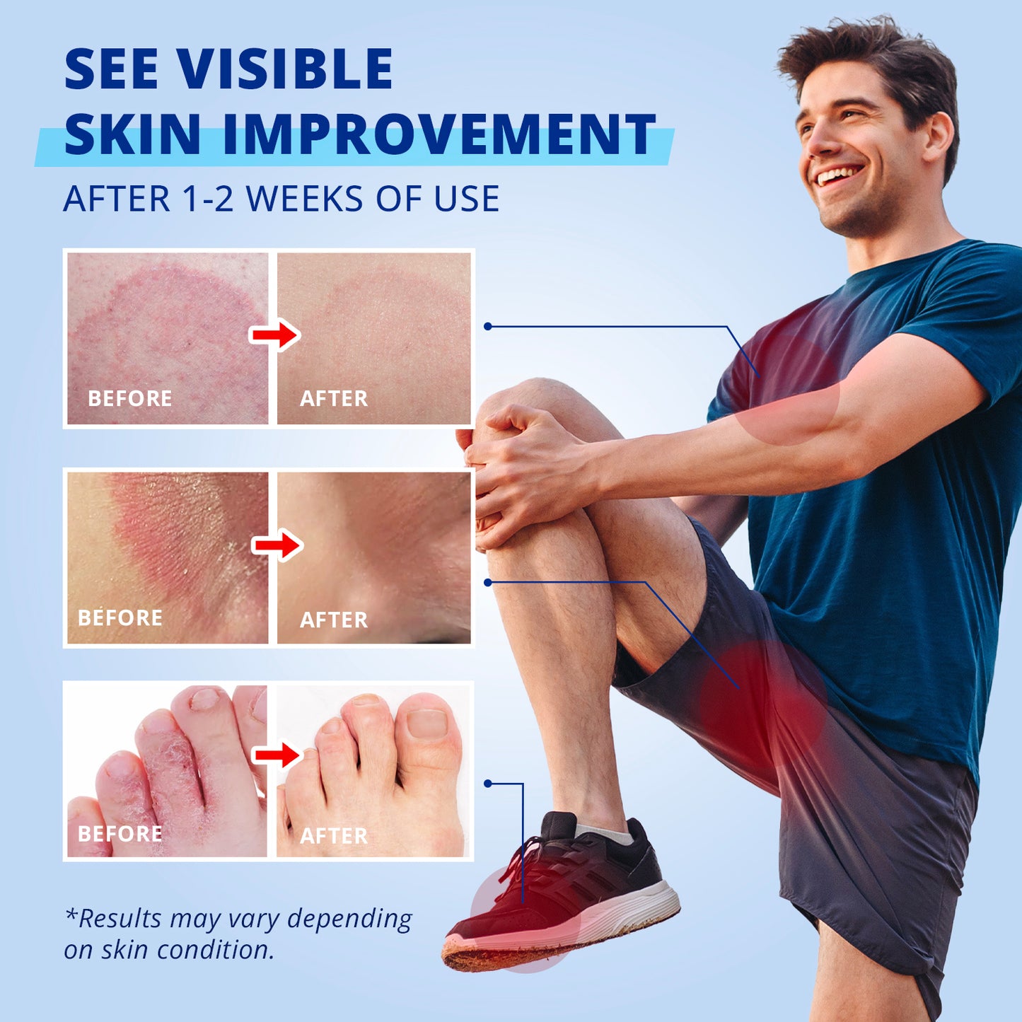 TAGRID jock itch cream with clotrimazole 1 percent supports visible skin improvement with before and after comparison over time