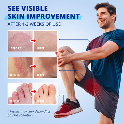 TAGRID jock itch cream with clotrimazole 1 percent supports visible skin improvement with before and after comparison over time