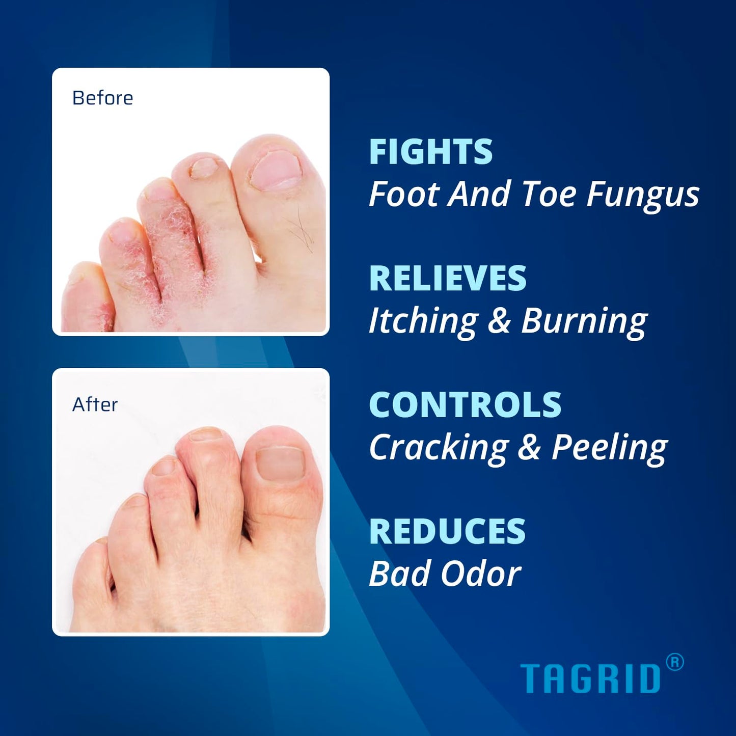 before and after showing improved foot skin appearance with antifungal cream helping relieve itching, burning, and discomfort