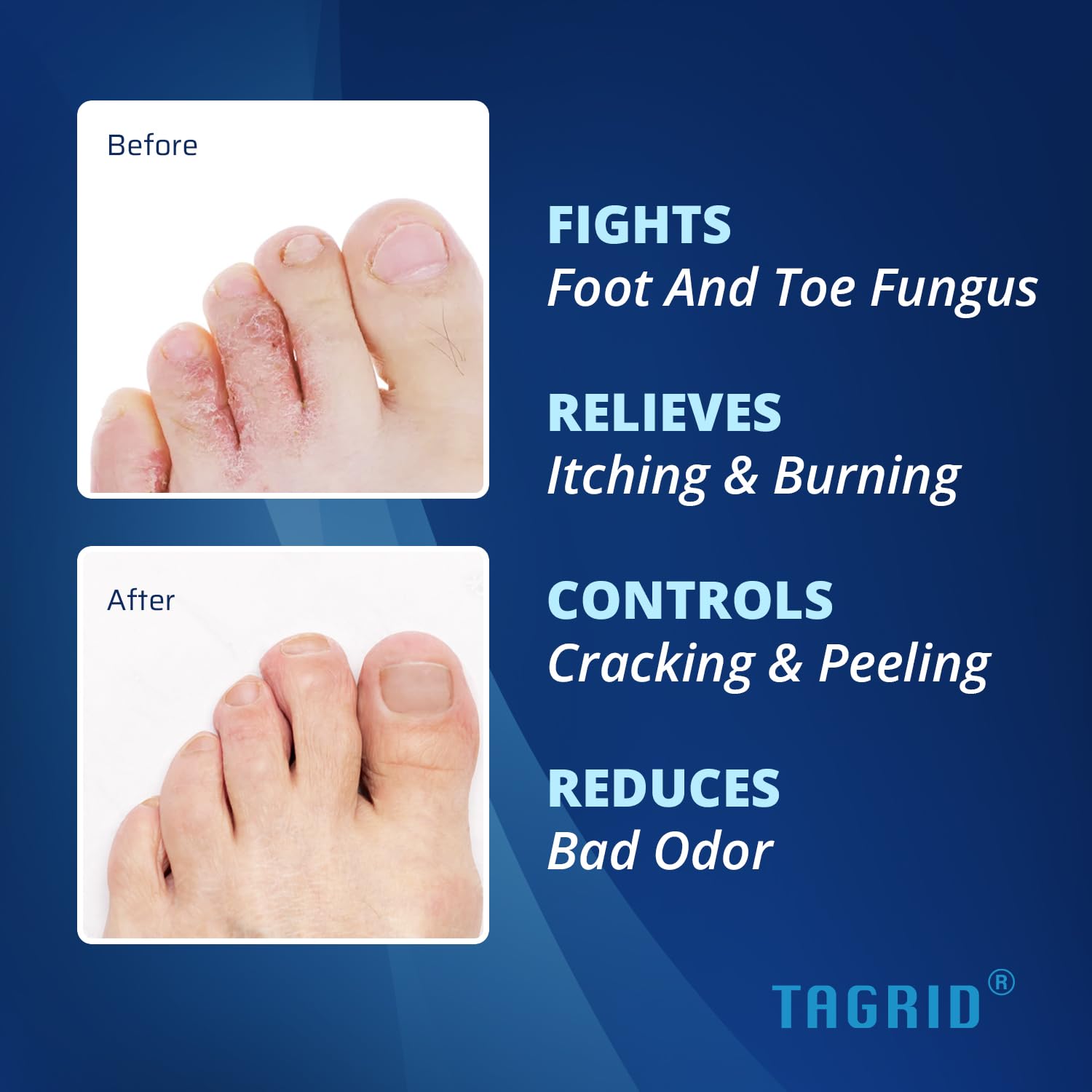 before and after showing improved foot skin appearance with antifungal cream helping relieve itching, burning, and discomfort