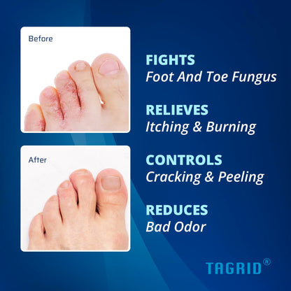 before and after showing improved foot skin appearance with antifungal cream helping relieve itching, burning, and discomfort