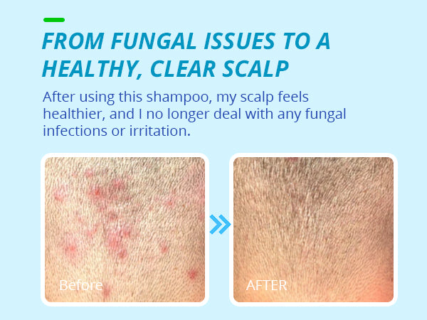 Before and after results with anti-fungal shampoo for healthy and clear scalp, treating fungal issues.