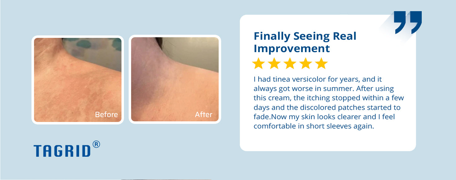 TAGRID antifungal cream ketoconazole 1% 100g before and after improvement for tinea versicolor showing clearer skin and reduced discoloration with consistent use