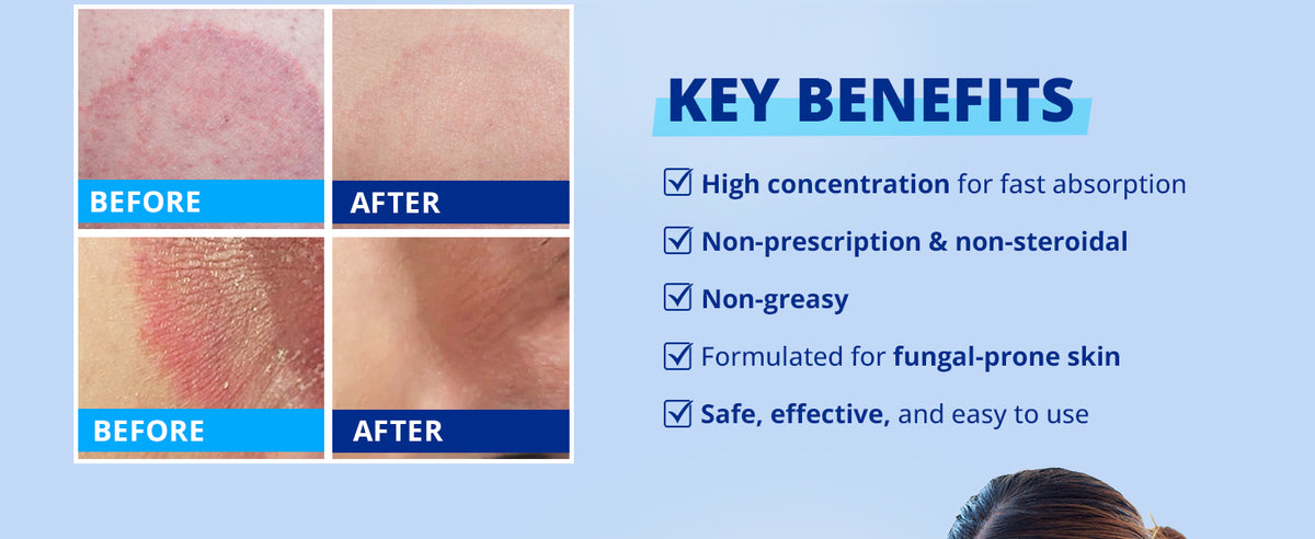 Antifungal jock itch cream with clotrimazole 1% shows before and after improvement of fungal skin with non greasy non steroidal formula for daily use