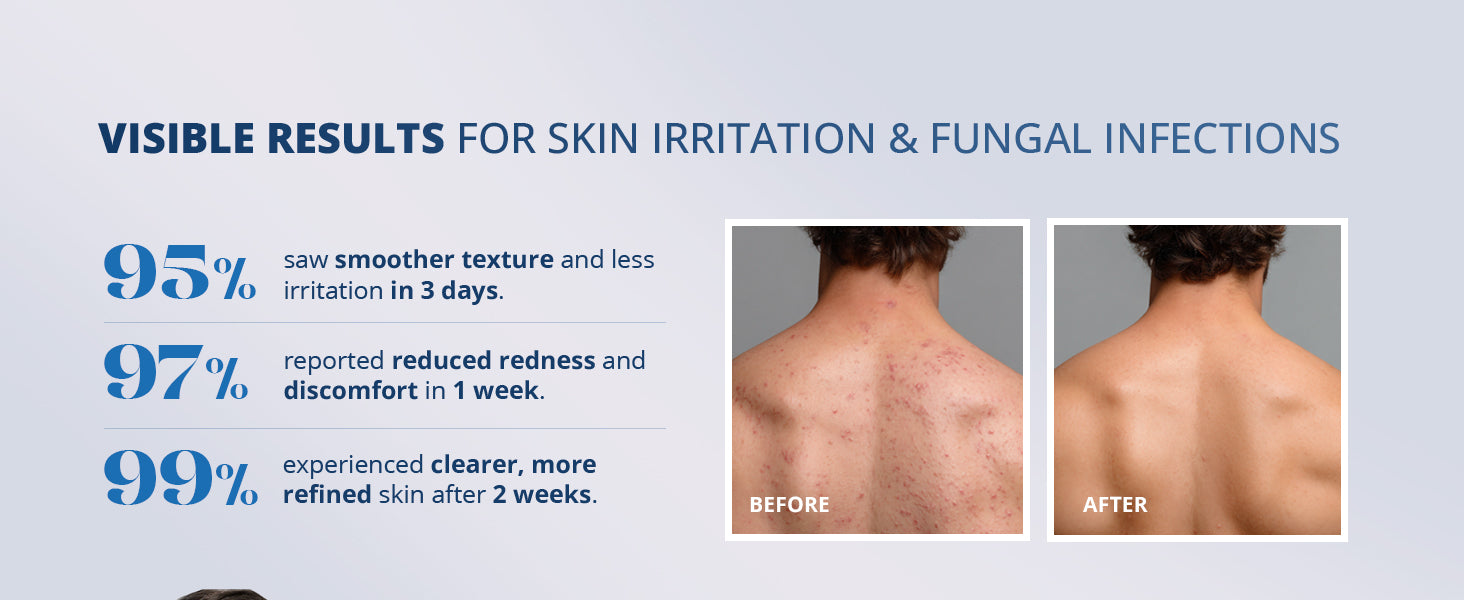 TAGRID antifungal soap results showing before and after skin improvement, helps reduce redness irritation and breakouts, supports clearer smoother skin with consistent daily cleansing use