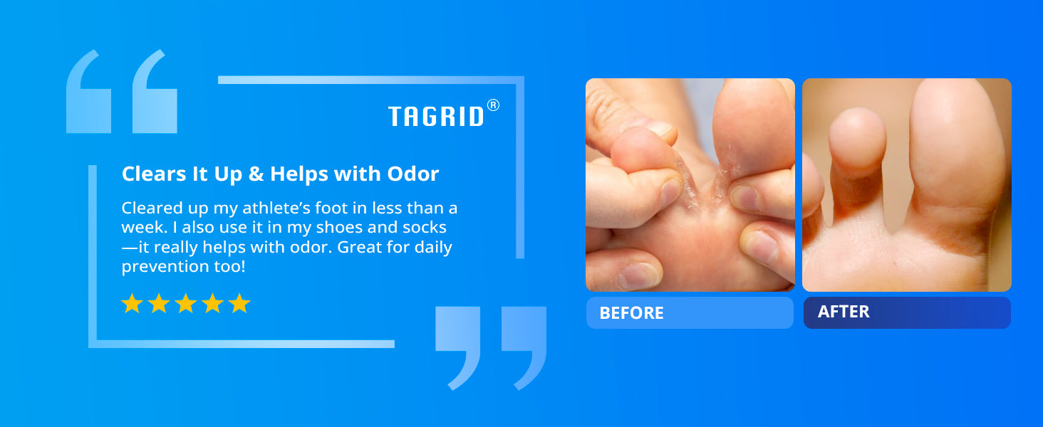 TAGRID antifungal spray with tolnaftate 1 athletes foot treatment before and after comparison shows improved foot fungus condition with clearer skin and helps reduce odor, itching and discomfort after regular use