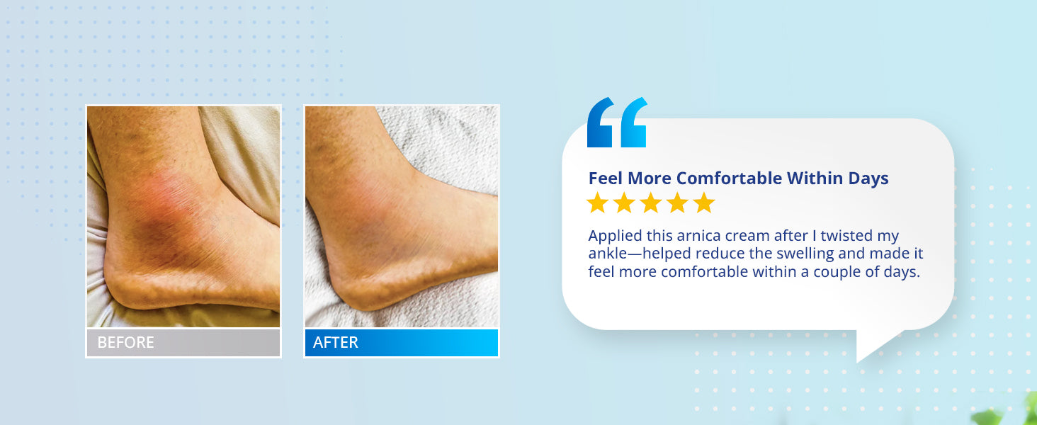 Before and after results of TAGRID Arnica Bruise Cream for ankle bruising and swelling