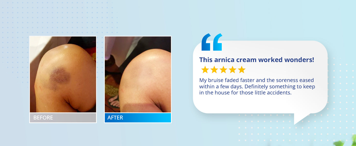 Before and after results of TAGRID Arnica Bruise Cream for bruise fading and soreness relief