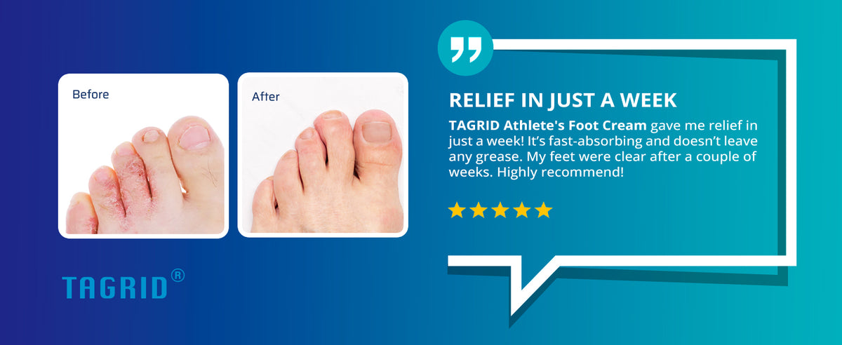 TAGRID athletes foot treatment with tolnaftate 1 antifungal cream before and after comparison shows improvement in foot fungus with clearer skin and reduced itching, burning and irritation after consistent use