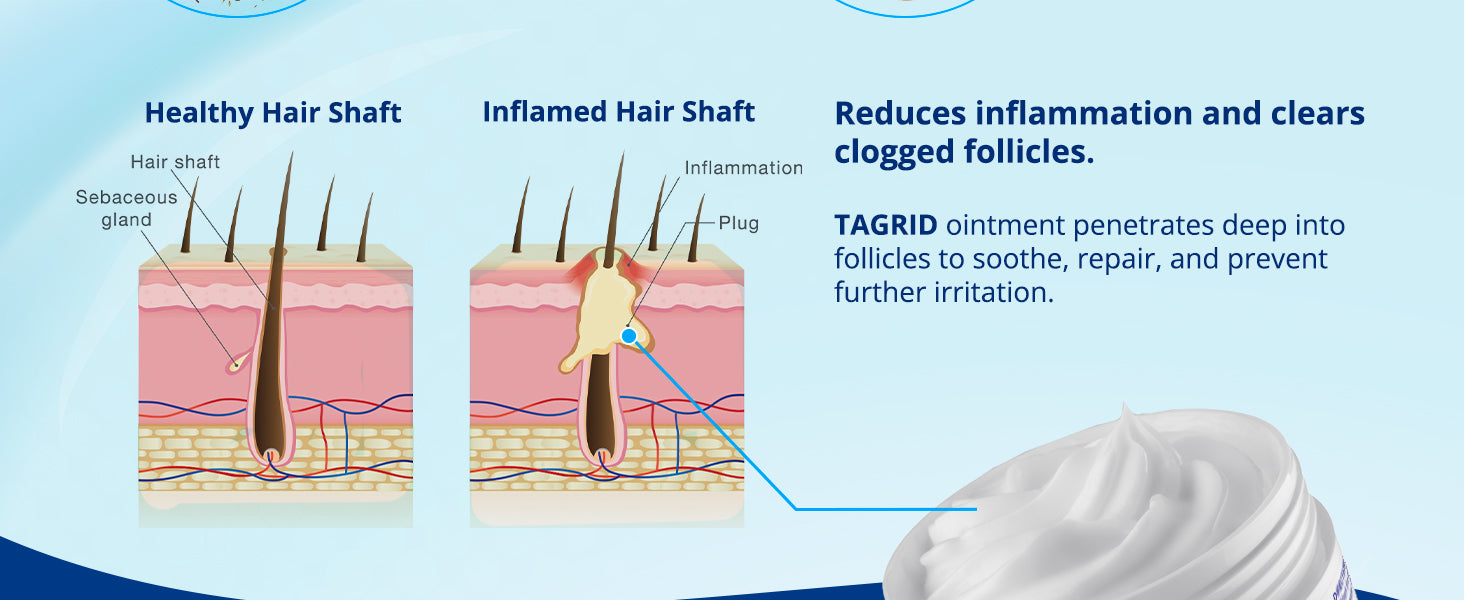 tagrid folliculitis treatment diagram, reduces inflammation and clears clogged hair follicles, helps repair irritated skin and prevent bumps, deep penetrating antifungal cream
