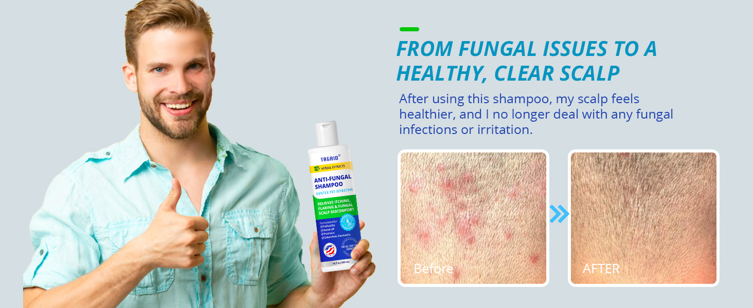 Before and after results with anti-fungal shampoo for healthy and clear scalp, treating fungal issues.