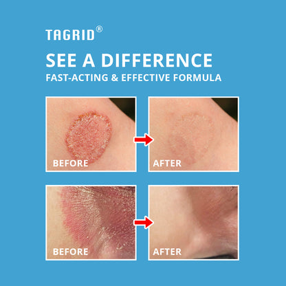 TAGRID jock itch antifungal cream with miconazole nitrate 2 percent supports skin appearance and daily comfort with consistent use
