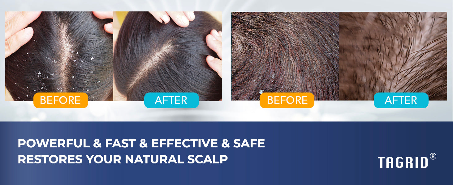 before and after dandruff scalp results using TAGRID ketoconazole shampoo, helps reduce flakes, buildup and itchy scalp for clearer healthier scalp appearance